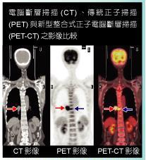 lq_hy(PET-CT)